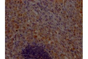 IHC image of ABIN7148184 diluted at 1:200 and staining in paraffin-embedded human ovarian cancer performed on a Leica BondTM system. (CHCHD5 antibody  (AA 1-110))