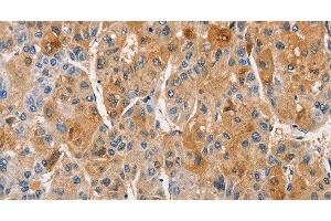 Immunohistochemistry of paraffin-embedded Human liver cancer using PKC epsilon Polyclonal Antibody at dilution of 1:50 (PKC epsilon antibody)