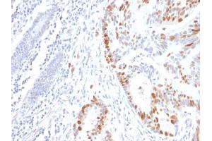 Formalin-fixed, paraffin-embedded human Colon Carcinoma stained with p53 Mouse Recombinant Monoclonal Antibody (rBP53-12). (Recombinant p53 antibody)