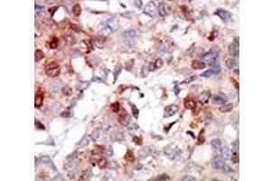 IHC analysis of FFPE human breast carcinoma tissue stained with the AKT3 antibody (AKT3 antibody  (AA 88-118))