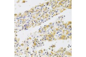 Immunohistochemistry of paraffin-embedded human gastric cancer using PA2G4 Antibody (ABIN5973112) at dilution of 1/100 (40x lens). (PA2G4 antibody)