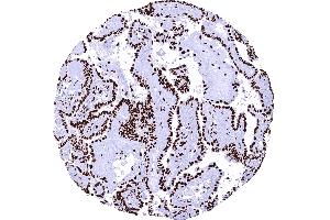 Papillary thyroid cancer with strong nuclear TRIM28 immunostaining of tumor cells