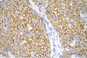 Immunohistochemistry was performed on paraffin-embedded human breast carcinoma using keratin 18 antibody (ABIN7799175), 1:200).