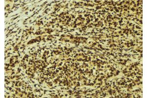 ABIN6274176 at 1/100 staining Human breast cancer tissue by IHC-P.