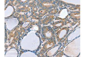 The image on the left is immunohistochemistry of paraffin-embedded Human thyroid cancer tissue using ABIN7192586(SNX29 Antibody) at dilution 1/20, on the right is treated with synthetic peptide. (SNX29 antibody)