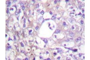 Immunohistochemistry analyzes of SH-PTP2 antibody in paraffin-embedded human breast carcinoma tissue. (PTPN11 antibody)