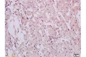 Formalin-fixed and paraffin embedded human hepatitides tissue labeled with Anti HBXIP Polyclonal Antibody,Unconjugated (ABIN873319) at 1:200 followed by conjugation to the secondary antibody and DAB staining.