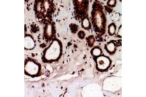 Immunohistochemical analysis of TSHZ2 staining in human prostate cancer formalin fixed paraffin embedded tissue section.