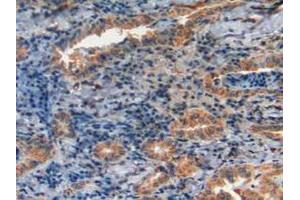 IHC-P analysis of Human Thyroid Cancer Tissue, with DAB staining.