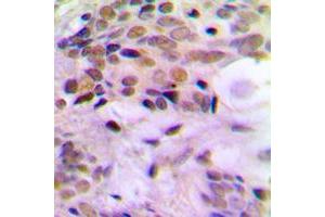 Immunohistochemical analysis of ERCC5 staining in human breast cancer formalin fixed paraffin embedded tissue section. (ERCC5 antibody  (N-Term))