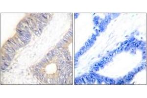 Immunohistochemistry analysis of paraffin-embedded human colon carcinoma tissue, using Stefin A Antibody.