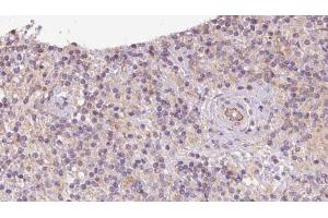 ABIN6273095 at 1/100 staining Human lymph cancer tissue by IHC-P. (CCDC22 antibody  (C-Term))