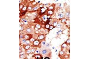 Formalin-fixed and paraffin-embedded human cancer tissue reacted with the primary antibody, which was peroxidase-conjugated to the secondary antibody, followed by DAB staining. (ACSL4 antibody  (AA 236-267))