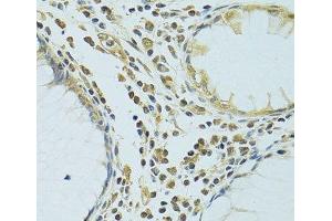 Immunohistochemistry of paraffin-embedded Human colon using METTL13 Polyclonal Antibody at dilution of 1:100 (40x lens). (METTL13 antibody)