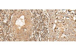 Immunohistochemistry of paraffin-embedded Human esophagus cancer tissue using GALR2 Polyclonal Antibody at dilution of 1:40(x200) (GALR2 antibody)