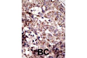 Formalin-fixed and paraffin-embedded human cancer tissue reacted with AGER polyclonal antibody  , which was peroxidase-conjugated to the secondary antibody, followed by AEC staining . (RAGE antibody  (N-Term))