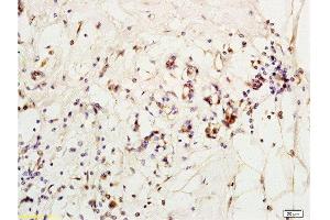 Formalin-fixed and paraffin embedded human breast carcinoma labeled with Anti-MCP-2 Polyclonal Antibody, Unconjugated  at 1:200 followed by conjugation to the secondary antibody and DAB staining (CCL8 antibody  (AA 24-99))