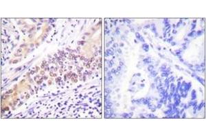 Immunohistochemistry analysis of paraffin-embedded human lung carcinoma tissue, using TOP2B Antibody.
