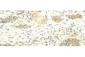 Immunohistochemistry of paraffin-embedded Human esophagus cancer tissue using ATMIN Polyclonal Antibody at dilution of 1:50(x200) (ATM Interactor antibody)