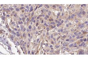 ABIN6272953 at 1/100 staining Human Melanoma tissue by IHC-P. (AGGF1 antibody  (Internal Region))