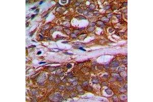 Immunohistochemical analysis of MRPL22 staining in human prostate cancer formalin fixed paraffin embedded tissue section. (MRPL22 antibody)