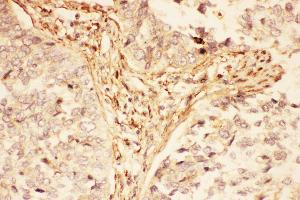 Anti-LIF Picoband antibody,  IHC(P): Human Lung Cancer Tissue (LIF antibody  (AA 23-202))