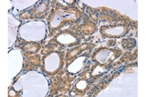 The image on the left is immunohistochemistry of paraffin-embedded Human thyroid cancer tissue using ABIN7131131(SNX4 Antibody) at dilution 1/25, on the right is treated with fusion protein. (Sorting Nexin 4 antibody)
