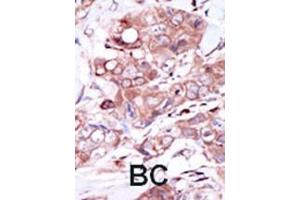 Formalin-fixed and paraffin-embedded human cancer tissue reacted with the primary antibody, which was peroxidase-conjugated to the secondary antibody, followed by DAB staining. (ERBB4 antibody  (C-Term))