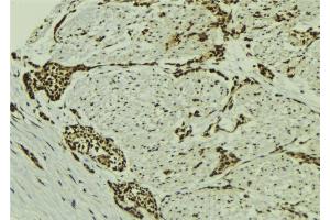 ABIN6273133 at 1/100 staining Human breast cancer tissue by IHC-P. (MGH1/2 antibody)
