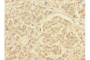 Immunohistochemistry of paraffin-embedded human pancreatic cancer using ABIN7167664 at dilution of 1:100 (Relaxin 3 Receptor 1 antibody  (AA 1-80))