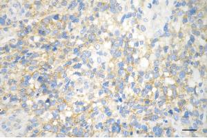 Immunohistochemistry was performed on paraffin-embedded human glioblastoma using huntingtin antibody (ABIN7799005), 1:200).
