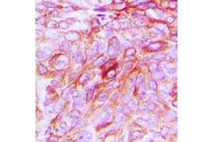 Immunohistochemical analysis of Phospholipase D4 staining in human breast cancer formalin fixed paraffin embedded tissue section. (Phospholipase D4 antibody  (C-Term))