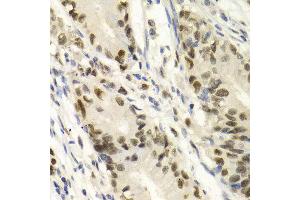 Immunohistochemistry of paraffin-embedded Human gastric cancer using KPNA4 antibody at dilution of 1:100 (x400 lens). (KPNA4 antibody  (AA 1-240))