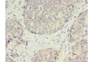 Immunohistochemistry of paraffin-embedded human gastric cancer using ABIN7175400 at dilution of 1:100 (Vasohibin 2 antibody  (AA 1-156))