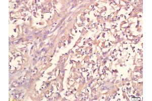 paraformaldehyde-fixed, paraffin embedded human lung carcinoma tissue, Antigen retrieval by boiling in sodium citrate buffer(pH6) for 15min, Block endogenous peroxidase by 3% hydrogen peroxide for 30 minutes, Blocking buffer (normal goat serum) at 37°C for 20min, Antibody incubation with Rabbit Anti-IL12 Polyclonal Antibody, Unconjugated  at 1:500 overnight at 4°C, followed by a conjugated secondary and DAB staining (IL12 antibody  (AA 51-150))