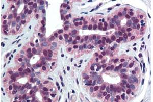 Human Breast (formalin-fixed, paraffin-embedded) stained with TNFRSF10B antibody ABIN290834 at 10 ug/ml followed by biotinylated goat anti-rabbit IgG secondary antibody ABIN481713, alkaline phosphatase-streptavidin and chromogen. (TNFRSF10B antibody  (AA 388-407))