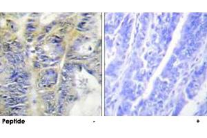 Immunohistochemistry analysis of paraffin-embedded human colon carcinoma tissue using COL4A5 polyclonal antibody . (COL4a5 antibody)