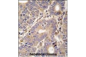 Formalin-fixed and paraffin-embedded human hepatocarcinoma tissue reacted with CARS2 antibody (C-term) (ABIN392315 and ABIN2841965) , which was peroxidase-conjugated to the secondary antibody, followed by DAB staining. (CARS2 antibody  (C-Term))