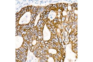 Immunohistochemistry of paraffin-embedded Human colon carcinoma using Cytokeratin 19 (KRT19) antibody (ABIN7268099) at dilution of 1:100 (40x lens). (Cytokeratin 19 antibody)