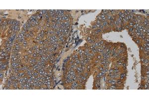 Immunohistochemistry of paraffin-embedded Human colon cancer tissue using MAS1 Polyclonal Antibody at dilution 1:50 (MAS1 antibody)