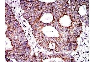 Immunohistochemical analysis of paraffin-embedded rectum cancer tissues using SOD2 mouse mAb with DAB staining. (SOD2 antibody  (AA 1-222))