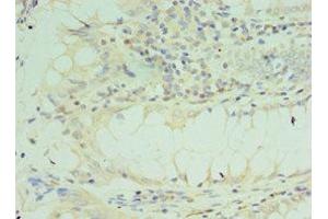 Immunohistochemistry of paraffin-embedded human colon cancer using ABIN7172205 at dilution of 1:100 (TICAM2 antibody  (AA 1-235))