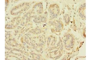 Immunohistochemistry of paraffin-embedded human breast cancer using ABIN7171326 at dilution of 1:100 (TAGAP antibody  (AA 97-260))