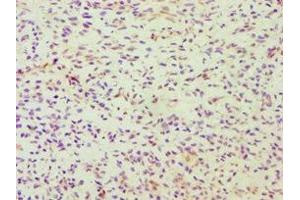 Immunohistochemistry of paraffin-embedded human breast cancer using ABIN7164363 at dilution of 1:100 (DDX5 antibody  (AA 1-290))