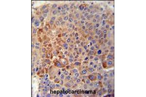 GPLD1 Antibody immunohistochemistry analysis in formalin fixed and paraffin embedded human hepatocarcinoma tissue followed by peroxidase conjugation of the secondary antibody and DAB staining. (GPLD1 antibody  (C-Term))