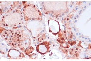 Immunohistochemistry of paraffin-embedded Human thyroid cancer using S100A5 Polyclonal Antibody at dilution of 1:100 (40x lens). (S100A5 antibody)