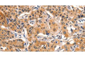 Immunohistochemistry of paraffin-embedded Human lung cancer tissue using AIM2 Polyclonal Antibody at dilution 1:60 (AIM2 antibody)