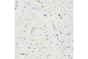 Immunohistochemistry of paraffin-embedded human breast cancer using GEMIN2 Antibody. (SIP1 antibody)
