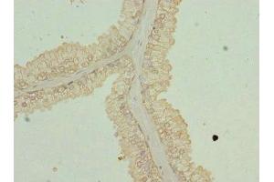 Immunohistochemistry of paraffin-embedded human prostate cancer using ABIN7162351 at dilution of 1:100