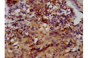 IHC image of ABIN7153231 diluted at 1:400 and staining in paraffin-embedded human ovarian cancer performed on a Leica BondTM system.